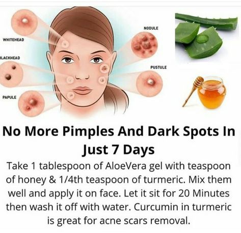 Pimple Solution, Blind Pimple, Pimples Under The Skin, Pimple Scars, Pimples Overnight, Pimples Remedies, Pimples On Face, Dark Spots On Face, Natural Face Skin Care