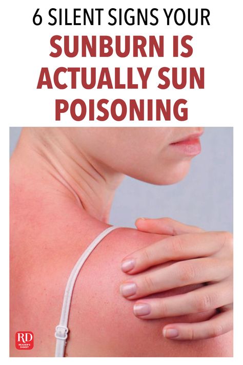 Severe Sunburn Remedies, Best Sunburn Remedy, Severe Sunburn Relief, Apple Cider Vinegar Sunburn, Sun Poisoning Rash, Really Bad Sunburn, Best For Sunburn, Blister Remedies, Sunburn Blisters