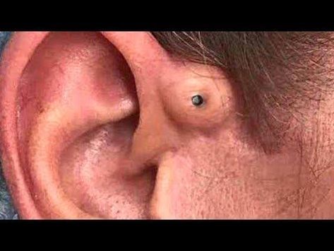 Big Nasty Ear Blackheads!  Dilated Pores of Winer Extravaganza Ear Blackheads, Neck Pimples, Black Heads Removal Video, Huge Pimple, Ear Pimple, Tonsil Stone, Squeezing Blackheads, Blackheads On Face, Big Pimple