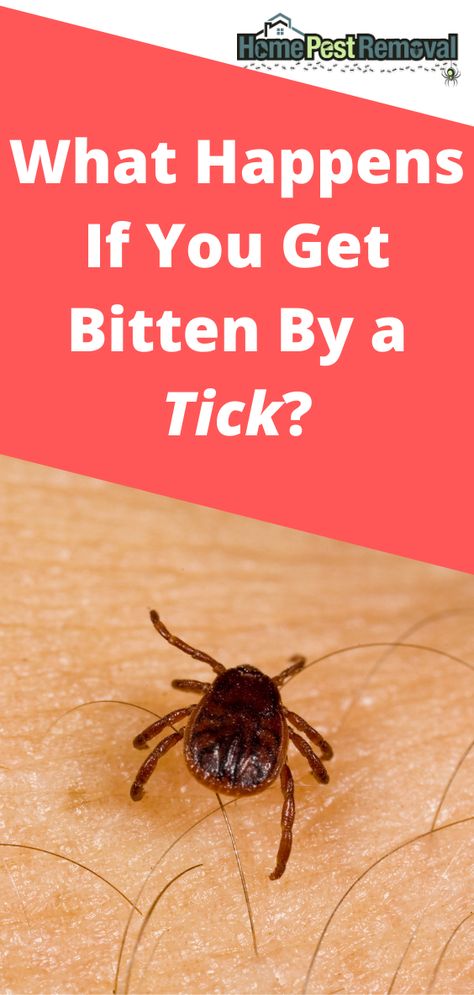 If you’ve stayed away from hiking, camping, and other outdoor activities because you’re afraid of getting a tick bite, that’s understandable. Ticks can transmit a variety of diseases. But, it’s not the end of the world if you do get bitten, so long as you’re able to catch it sooner rather than later. What happens if you get bitten by a tick? Tick Bites Pictures, Tick Bite Symptoms, Mosquito Bites Stop Itching, Fever Symptoms, Deer Ticks, Tick Bite, Mosquito Bites, Cramps Relief, Mosquito Bite