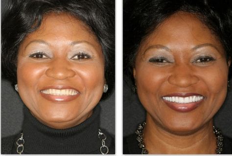 https://www.foydentures.com/before-and-afters/ Dentures Before And After, Dentures Before And After Immediate, Permanent Dentures, Gallery Pictures, Dentures, Critical Thinking Skills, View Pictures, Thinking Skills, Health And Fitness Tips