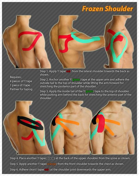 Kinesiology taping instructions for frozen shoulder #ktape #frozenshoulder #ares Shoulder Exercises Physical Therapy, Frozen Shoulder Exercises, Punkty Spustowe, K Tape, Shoulder Rehab, Kinesio Taping, Shoulder Surgery, Frozen Shoulder, Frosé