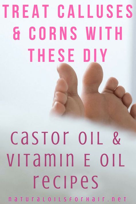 Treat Calluses and Corns with these DIY Castor Oil & Vitamin E Recipes Callus Remover Diy, Corn Removal, Castor Oil Benefits, Homemade Oil, Callus Removal, Oil Benefits, Vitamin E Oil, Oil Recipes, Simple Skincare