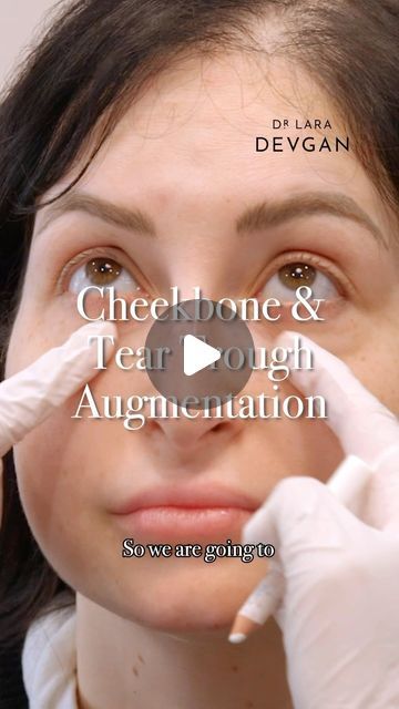 Dr. Lara Devgan, MD, MPH, FACS on Instagram: "The cheekbone is a beautiful area to create a little bit of structure and smoothness in the lid cheek junction. The tear trough is a key area to maintaining a fresh and awake look. Through my signature nonsurgical #facialoptimization, I use hyaluronic acid based filler to subtly replenish the face for a natural appearance. 

#devganoptimization #plasticsurgery #plasticsurgeon #beautyisinthedetails" Tear Trough Remedy Natural, Cheekbone Filler Before And After, Tear Trough Filler Before After, Tear Trough Filler, Tear Trough, Cheek Fillers, My Signature, Plastic Surgeon, Plastic Surgery