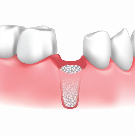 The reason that might require a Bone Graft: 1. Diseases of the bone, such as osteonecrosis. 2. Spinal fusion surgery. 3. Dental implant surgery. 4. Surgically implanted devices. For all your dental needs click on - goo.gl/Wcsebp Spinal Fusion Surgery, Bone Grafting, Spinal Fusion, Dental Implant Surgery, General Dentistry, Dental Implant, Root Canal, Dentures, Cosmetic Dentistry