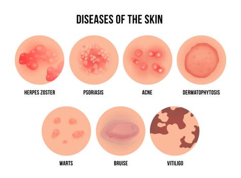 Skin Rashes Pictures, Skin Disease Pictures, Types Of Skin Rashes, Skin Logo, Health Icon, Natural Antibiotics, Healthy Liver, Skin Disorders, Medical Knowledge