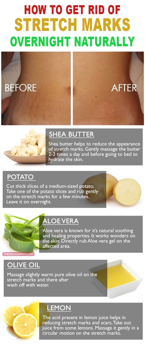 Stretch Mark Removal, Natural Healing Remedies, Baking Soda Shampoo, Natural Therapy, Skin Healing, Natural Home Remedies, Skin Tips, Cleaning Tips, Natural Healing