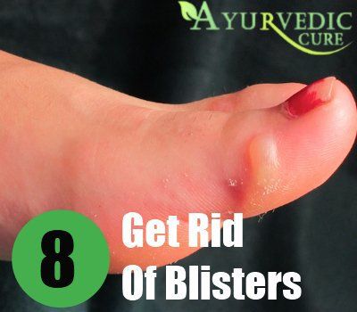 Get Rid Of Blisters Sun Blisters, How To Treat Blisters, Heal Blisters, Water Blister, Blister Remedies, How To Heal Blisters, Blister Care, Blood Blister, Skin Blisters