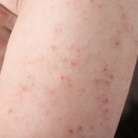 Picture of an arm with a dermatitis herpetiformis rash from eating too much gluten Skin Rashes Pictures, Allergy Rash, Itchy Skin Rash, Itchy Rash, Home Remedies For Skin, Home Remedies For Acne, Sports Medicine, Itchy Skin, Skin Problems