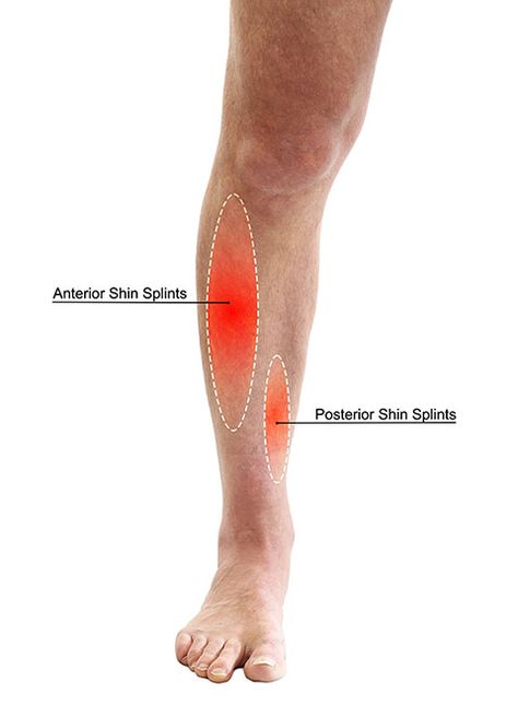 Shin Splints: What causes them and how to fix them | Petersen Physical Therapy Chin Splints Remedy, Anterior Shin Splints, Shin Splints Stretches, Shin Splint Exercises, Leg Cramps At Night, Lower Leg Muscles, Calf Cramps, Swollen Knee, Kinesiology Taping