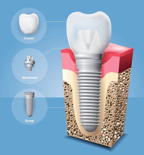 Dental Illustration, Prosthetic Teeth, Free Dental Implants, Dental Advertising, Dentist Teeth, Dental Images, Best Dental Implants, Oral Surgeon, Human Teeth