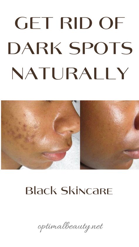 Black Skin Care Dark Spots, Dark Spot Remover For Face, Get Rid Of Dark Spots, Oily Skin Remedy, Dark Spots On Face, Natural Face Skin Care, Black Skin Care, Spots On Face, Remove Dark Spots