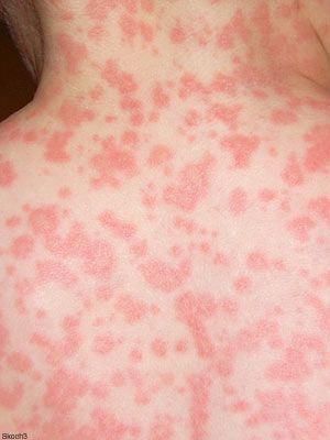 Skin conditions can be hard to diagnose as many cause a similar looking skin bump or blemish. Learn about skin rashes and telltale signs to tell them apart. Common Skin Rashes, Multiple Chemical Sensitivity, Heat Rash, Home Remedies For Skin, Skin Rashes, Skin Bumps, Vitamin Deficiency, Natural Acne Remedies, Dry Skin Remedies