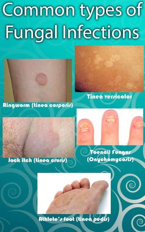 Skin Fungus, Tinea Versicolor, Toenail Fungal Infection, Fungal Infection Skin, Toenail Fungus Remedies, Natural Antibiotics, Nursing Tips, Toenail Fungus, Fungal Infection