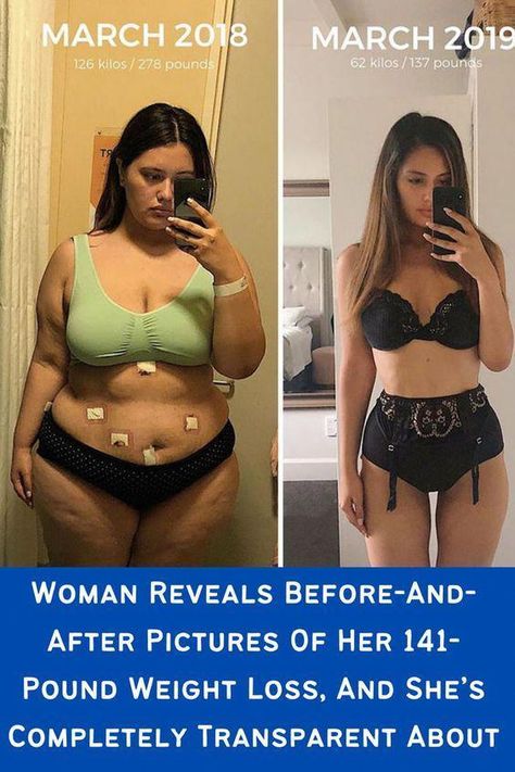 Ariana Omipi is one of those people who refuse to give up despite all of the hate that Bariatric Sleeve, Image Positive, Sleeve Surgery, After Pictures, Before And After Pictures, Lose 50 Pounds, Transformation Body