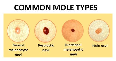 Should You Get That Pesky Skin Mole Removed? If So, How? Mental Health First Aid, Skin Moles, Mole Removal, Healthy Grains, Heart Conditions, Immune Health, Design Sponge, Autoimmune Disease, Eye Health