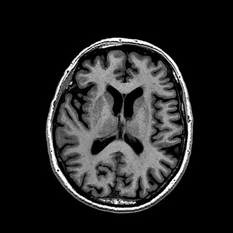 Transverse view of the brain of a 75 year old male, taken with MRI. MRI scans give very high quality images, with excellent contrast between the different types of tissues, this makes it is one of the best techniques for imaging the brain. Brain Cross Section, Mri Brain Anatomy, Ct Scan Brain Anatomy, Brain Mri, Mri Brain Scan Image, Brain Scan Neuroscience, Tissue Types, Mri Scan, Brain Scan