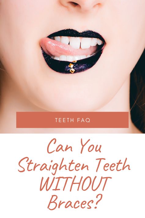 How To Get Straight Teeth, Straighten Teeth At Home, Straight Teeth Without Braces, Straighten Teeth Without Braces, Different Types Of Braces, Orthodontics Teeth, Straighten Teeth, Flossing Teeth, Lingual Braces