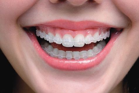 Perfect Teeth Braces, Invisible Braces Teeth, Orthodontics Teeth, Zoom Teeth Whitening, Ceramic Braces, Cute Braces Colors, Types Of Braces, Braces Tips, Invisible Braces