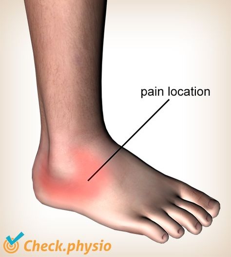 Lateral ankle ligament injury | Physio Check Anterior Talofibular Ligament Injury, Ankle Tendons And Ligaments, Torn Ligament In Ankle, Ankle Problems, Achilles Pain, Triage Nursing, Ankle Ligaments, Ankle Fracture, Ankle Injuries