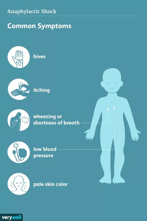 Anaphylaxis: Signs, Symptoms, and Complications Pale Skin Color, Brain Surgeon, Low Estrogen Symptoms, Anaphylactic Shock, Too Much Estrogen, Low Blood Pressure, Sciatic Nerve Pain, Emergency Care, Diy Hair Care