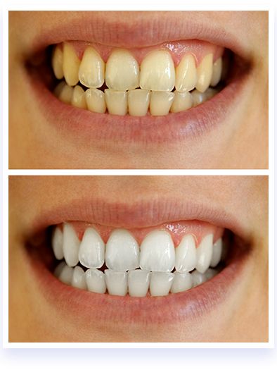 Have White Teeth Red Wine Stains, Teeth Bleaching, Teeth Whitening System, Yellow Teeth, Wine Stains, Tooth Enamel, Red Led Lights, Natural Teeth Whitening, White Smile