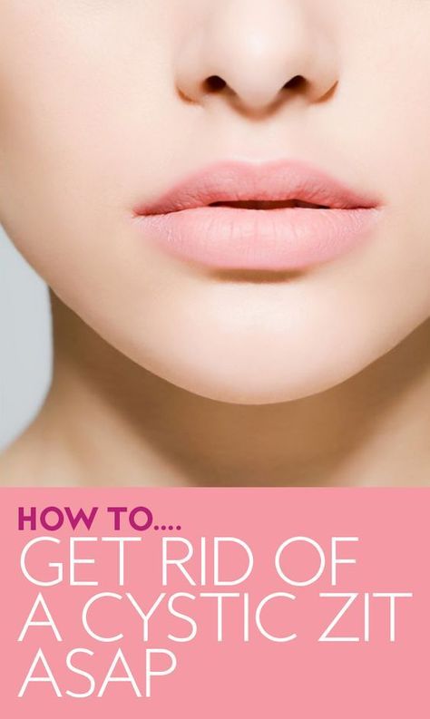 How to Get Rid of a Cystic Zit ASAP. #cysticacne #acneremedies #acnetips #skincaretips Treating Cystic Acne, Acne Overnight, Makeup 2018, Perfect Cat Eye, Cat Eye Makeup, Cystic Acne, Acne Remedies, Best Beauty Tips, In Between