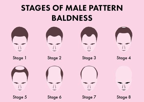 8 stages of hair loss in male pattern baldness. Androgenetic Alopecia, New Hair Do, Pattern Hair, Stimulate Hair Follicles, Male Pattern Baldness, Pattern Baldness, Bald Hair, Scalp Health, Hair Regrowth