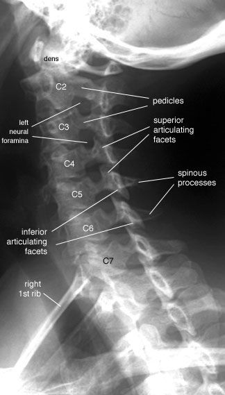 Cervical Spine X-ray | Cervical Spine -- Left Anterior Oblique View, Labelled Radiology Schools, Medical Radiography, Radiology Student, Radiology Imaging, Cervical Spondylosis, Radiology Technologist, Medical Student Study, Diagnostic Imaging, Cervical Spine