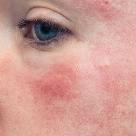 Skin Redness: Why Is My Skin So Blotchy? | Eminence Organic Skin Care Red Blotchy Skin, Forehead Acne, Acne Overnight, Eminence Organic Skin Care, Skin Photo, Skin Redness, Sensitive Skin Care, Skin Disorders, Dry Skin Care