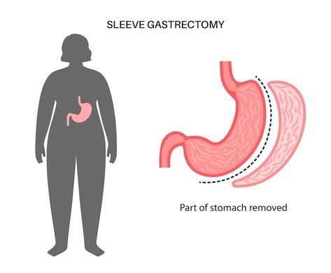 Vertical sleeve gastrectomy laparoscopy ... | Premium Vector #Freepik #vector #gastric-sleeve #gut #bariatric-surgery #digestive-system Medical Brand, Vertical Sleeve Gastrectomy, Vision Bored, Sleeve Gastrectomy, Sleeve Surgery, Maintain Weight, Medical Tourism, Tummy Tucks, 2024 Vision