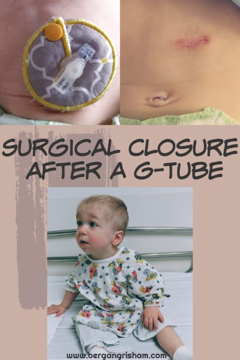 Healing After Having a G-Tube – Just Be Happy, Mommy -- tubie -- feeding tube -- laryngomalacia -- supraglottoplasty -- dysphagia -- thickened feeds -- preemie -- IUGR -- 36 weeker -- tube fed baby -- tubie journey -- surgical closure -- healing from a g-tube Surgery Prep, Feeding Tube Awareness, Nicu Graduate, Wheelchair Costumes, Failure To Thrive, Happy Mommy, Feeding Tube, Just Be Happy, Basement Flooring