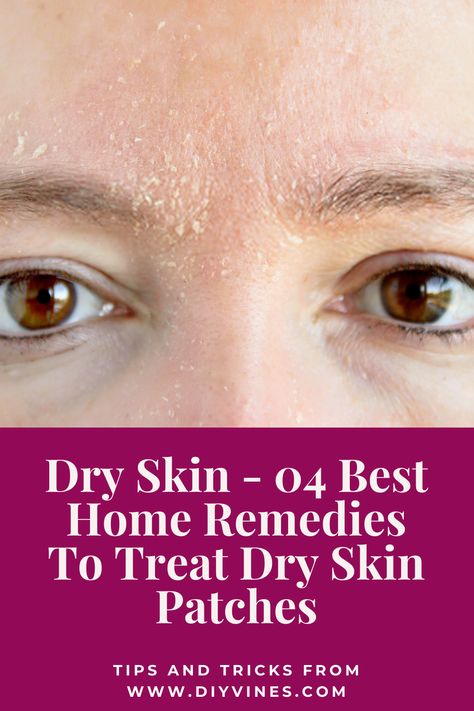 How To Get Rid Of Dry Skin Around Nose, Remedy For Dry Skin On Face, Extremely Dry Skin Remedies, How To Get Rid Of Rough Skin On Face, How To Treat Dry Skin On Face, Home Remedy For Dry Skin On Face, Dry Patches On Skin, How To Treat Dry Skin, Flaky Skin On Face Remedies