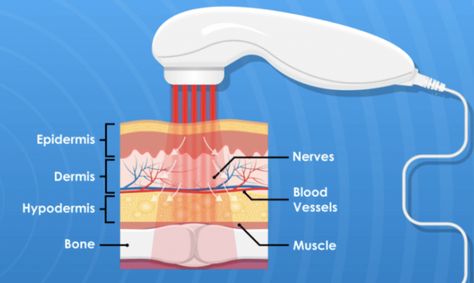 Anatomy 101, Cold Laser Therapy, Therapy Clinic, Low Level Laser Therapy, Healing Light, Laser Light, Integrative Health, Body Tissues, Laser Therapy