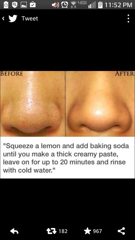 Black head remover diy Obličejové Masky, Exposed Skin Care, Blackhead Remover Diy, Diy Acne, Smink Inspiration, Skin Pores, Skin Remedies, Dr Oz, Lifestyle Tips