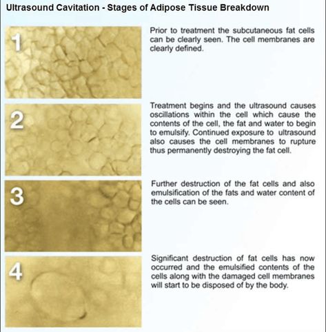 How ultrasound cavitation works Ultrasound Cavitation, Body Fat Reduction, Radio Frequency Skin Tightening, Laser Lipo, Ultrasonic Cavitation, Permanent Cosmetics, Cool Sculpting, Adipose Tissue, Medical Spa