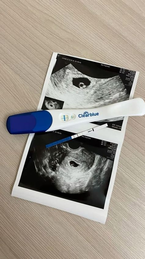 Ultrasound Picture Ideas, Baby Manifestation, Pregnancy Test Announcement, 2024 Baby Announcement, Pregnant Announcement, Announcement Pictures, Cute Pregnancy Pictures, Baby Ultrasound, Pregnancy Pictures