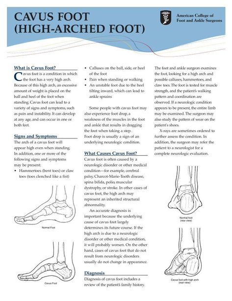 CAVUS FOOT (HIGH-ARCHED FOOT) Foot Exercises, High Arches, Gym Life, Read More, Arch, Gym