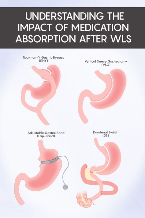 Duodenal Switch Surgery, Gastric Bypass Revision Surgery, Modified Duodenal Switch, Wls Before And After, Sadi-s Surgery, Bariatric Portions, Sleeve Surgery Before And After, No Chew Foods After Surgery Bariatric, Gastric Bypass Before And After