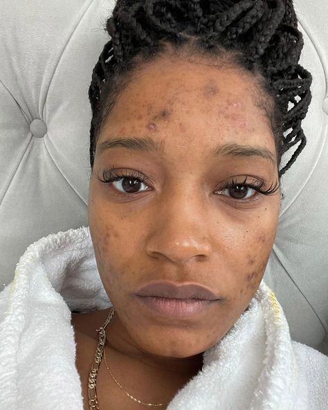 Girl With Acne, Cystic Ovarian Syndrome, Kandee Johnson, Unedited Photos, Barbie Ferreira, Keke Palmer, Popsugar Beauty, Bare Face, Lose 40 Pounds