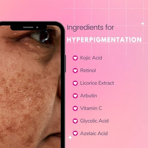 Pigmentation Remedy, Korean Skin Care Secrets, Post Inflammatory Hyperpigmentation, Skin Facts, Skin Care Business, Natural Acne Remedies, Brown Spots Removal, Best Eye Cream, Skin Care Clinic