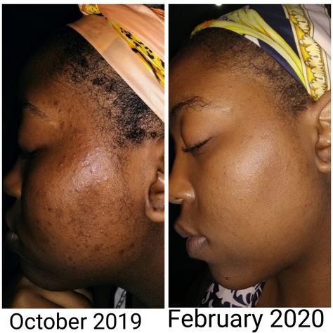 Urban skin rx / before and after photos / review of urban skin rx even tone cleansing bar for dark spots, hyperpigmentation, acne marks and blemishes. Pimples On Scalp, Remove Skin Tags Naturally, Skin Moles, Mole Removal, Skin Tags, Healthy Routine, Acne Marks, Glowing Complexion, Skin Issues