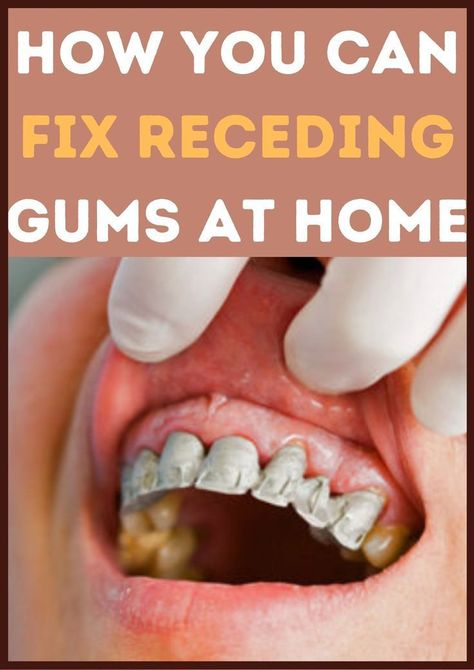 Rebuild Your Teeth and Gums And Get Rid of Tooth Decay. Do This 60 Seconds Dental Trick Before Going to Bed Tonight To Rebuild Your Teeth and Gums. Click the link and watch the full video. #gumcare #teethcare #teethcleaning #teethfixed #toothproblem #gumproblems Fix Receding Gums, Grow Back Receding Gums, Reverse Cavities, Tooth Decay Remedies, Tooth Repair, Teeth Health, Tooth Pain, Gum Care, Receding Gums