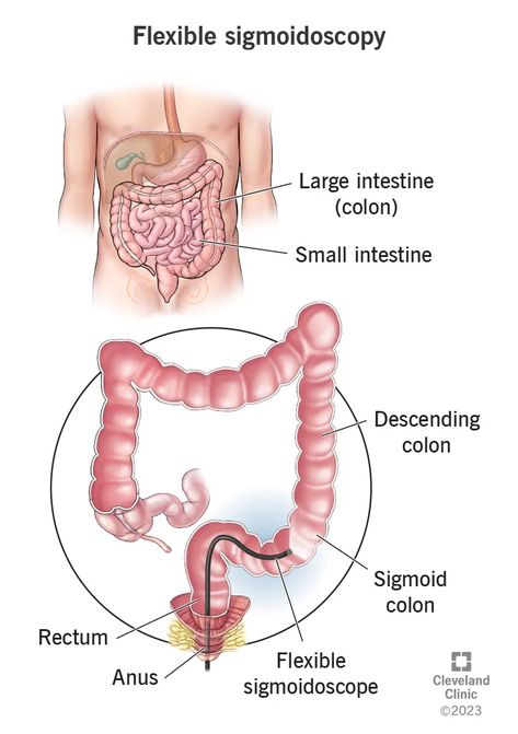 This short procedure looks inside just the lower part of your colon, rectum and anus. Clear Liquid Diet, Lower Abdominal Pain, Sigmoid Colon, Red Hair Trends, Passing Gas, Gastrointestinal System, Liquid Diet, Large Intestine, Pelvic Pain