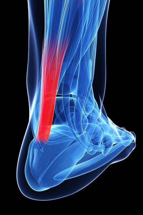 Do You Need Surgery for a Ruptured Achilles Tendon? Achilles Tendon, Bones