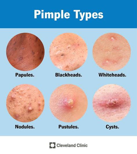 Pimple Types, Pustules Acne, Redness Pimple, Pimple Causes, Big Pimple, Cystic Pimple, How To Clear Pimples, Blind Pimple, Pimples Under The Skin