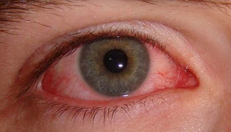 How long does pink eye last? 7 signs you are still contagious Treating Pink Eye, Pink Eye Home Remedies, Natural Pink Eye Remedy, Pinkeye Remedies, Health Tricks, Medicine Recipes, Healthy Healing, Bloodshot Eyes, Allergy Remedies