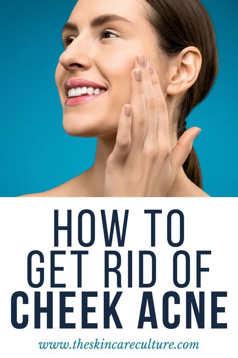 There are many ways you can get rid of cheek acne, however, the most important thing to do is to pay attention to good skincare practices, especially your cleansing and exfoliating habits.   Therefore, in this article, we will discuss everything you need to know about what causes acne on the cheeks, does drinking water really help acne, and how to get rid of cheek acne. Cheek Acne Cause, Cheek Breakouts, Cheek Acne, Acne Causing Foods, Face Mapping Acne, Good Skincare, Bad Acne, Face Mapping, Face Care Routine