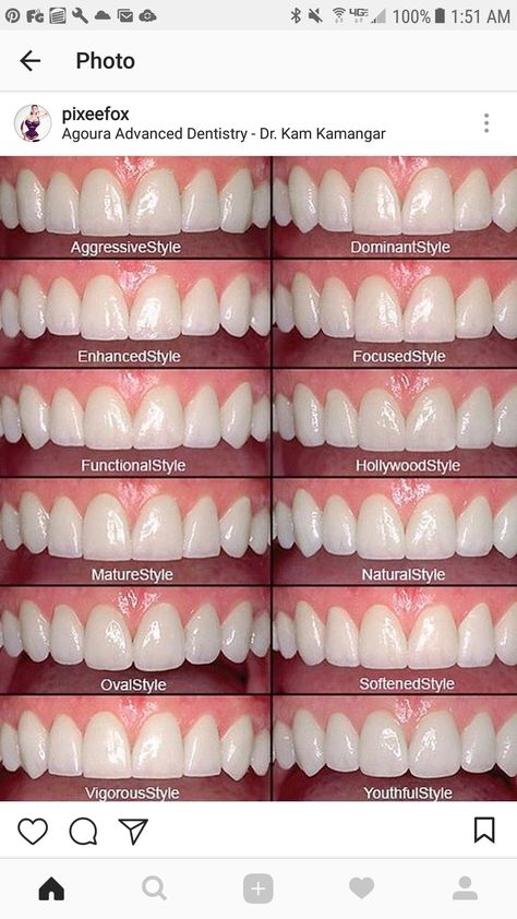 Cosmetic Dentistry Procedures, Veneers Teeth, Beautiful Teeth, Porcelain Veneers, Perfect Teeth, Teeth Shape, Dental Veneers, Smile Teeth, Smile Makeover