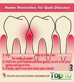 Home Remedies for Gum Disease Gums Receding, Loose Teeth, Swollen Gum, Top 10 Home Remedies, Loose Tooth, Teeth Health, Gum Care, Receding Gums, Oil Pulling